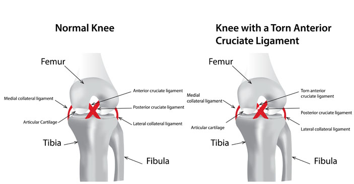 knee injury